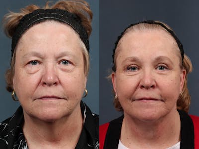 Facelift Before & After Gallery - Patient 169935 - Image 1