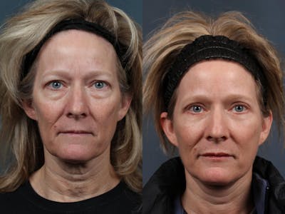 Facelift Before & After Gallery - Patient 215300 - Image 1