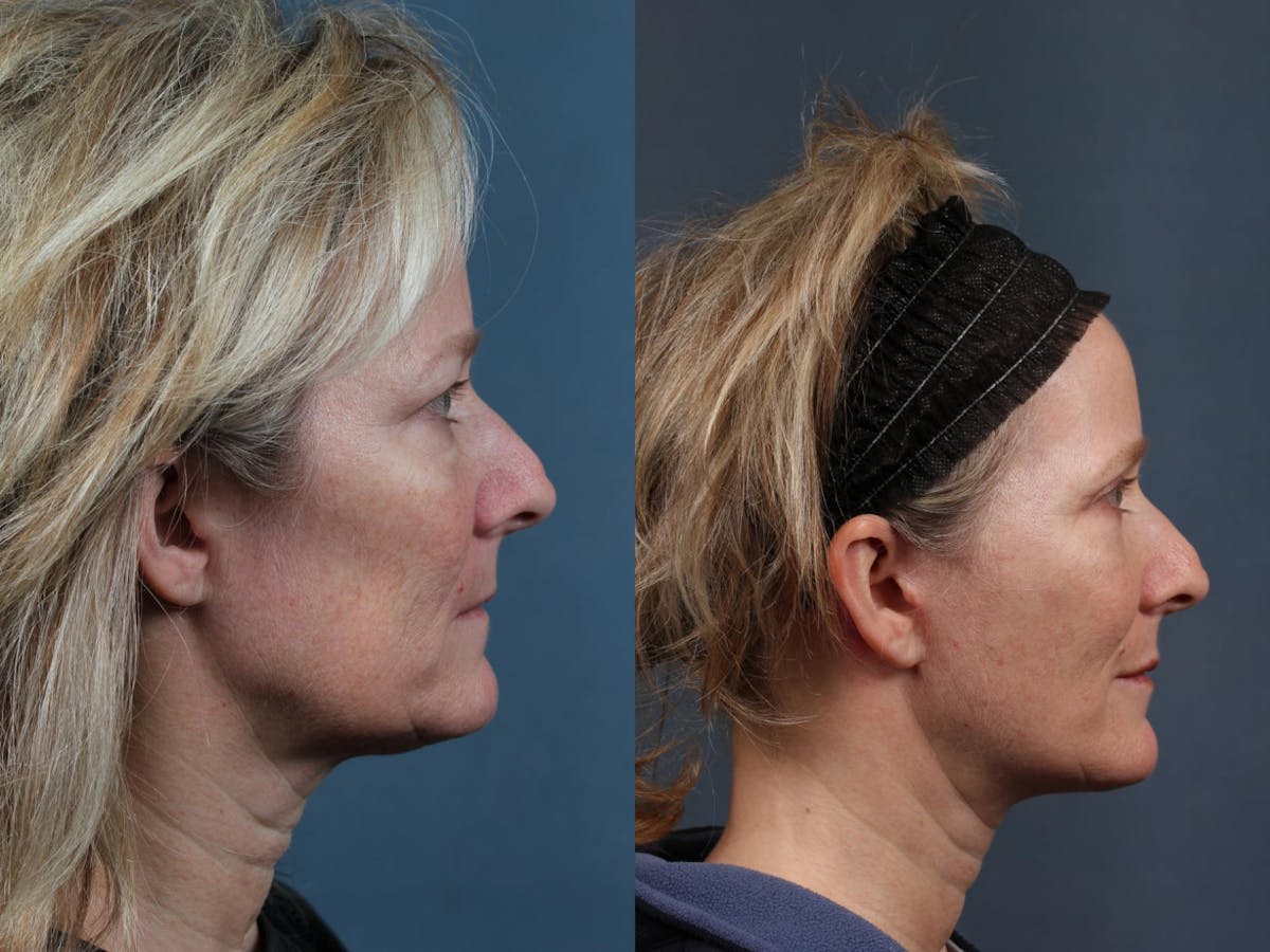 Facelift Before & After Gallery - Patient 215300 - Image 3