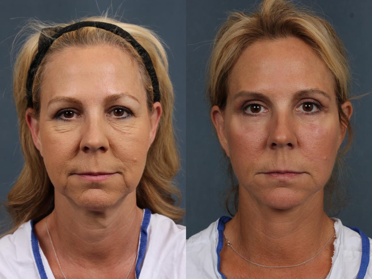 Facelift Before & After Gallery - Patient 354947 - Image 1