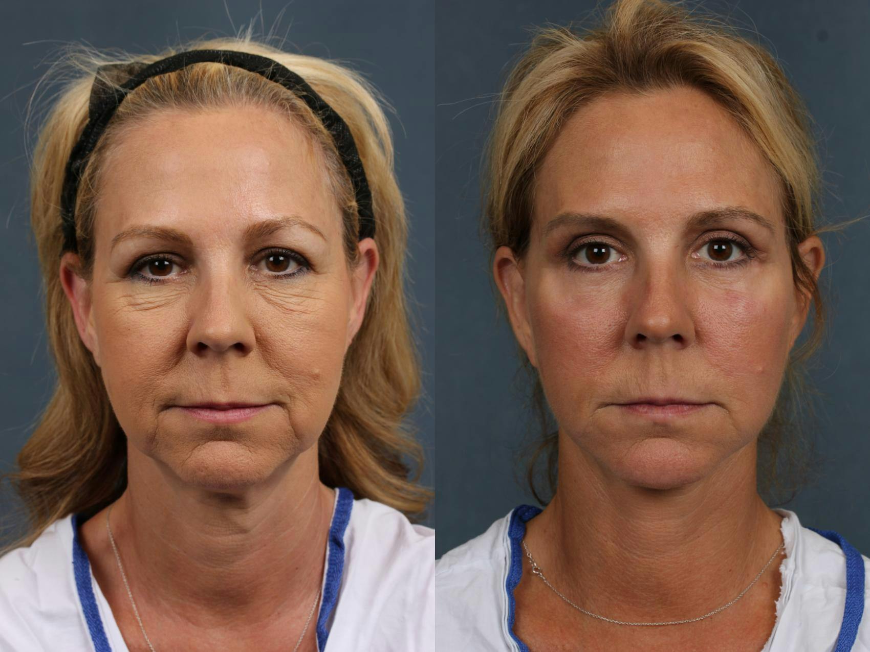 Facelift Before & After Gallery - Patient 354947 - Image 1