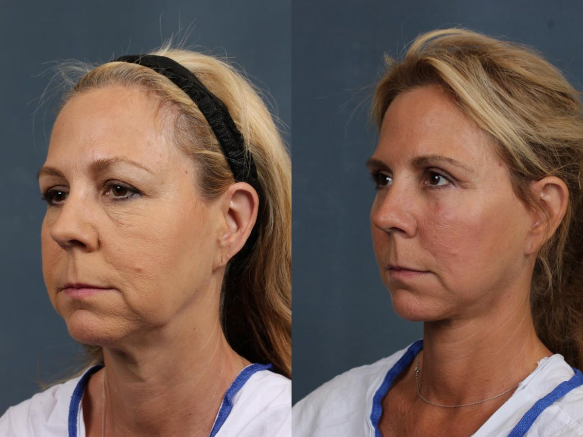 Facelift Before & After Gallery - Patient 354947 - Image 2