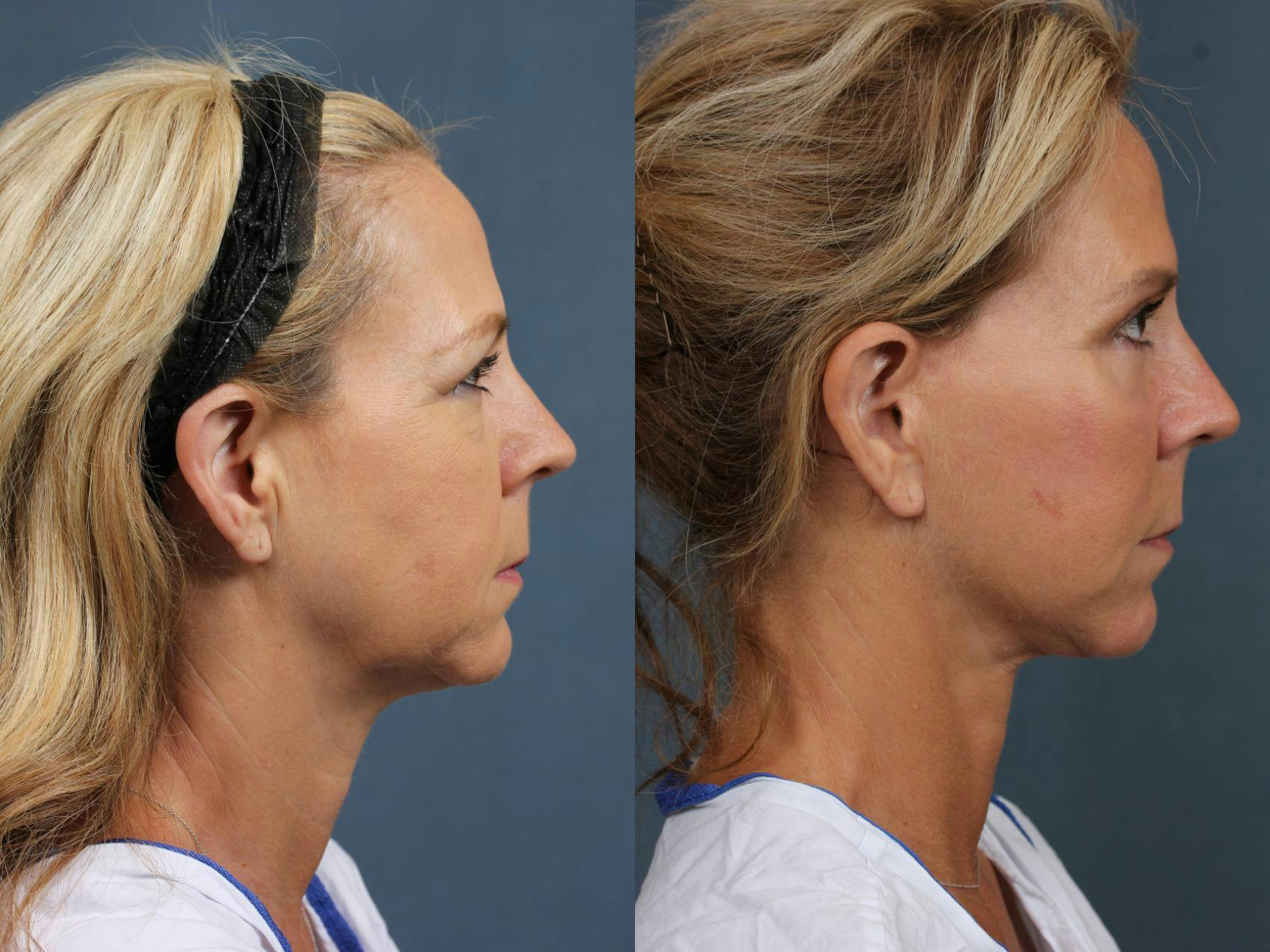 Facelift Before & After Gallery - Patient 354947 - Image 3