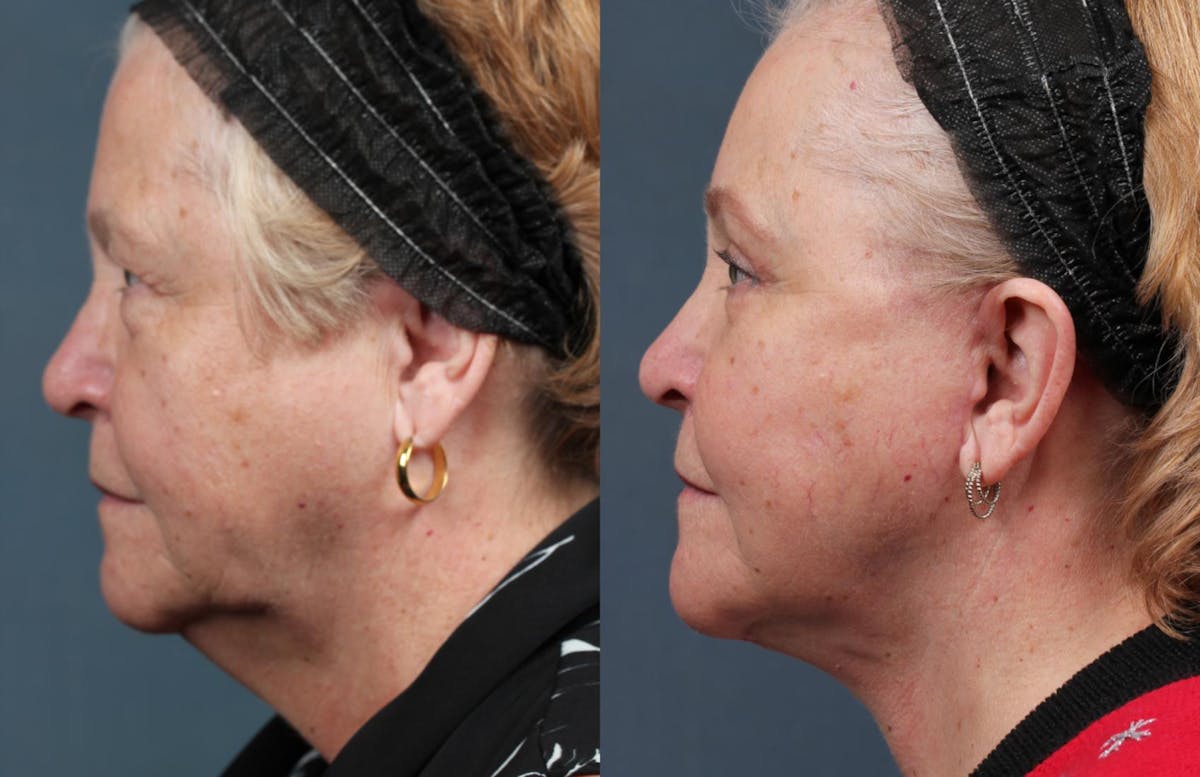 Facelift Before & After Gallery - Patient 385469 - Image 2