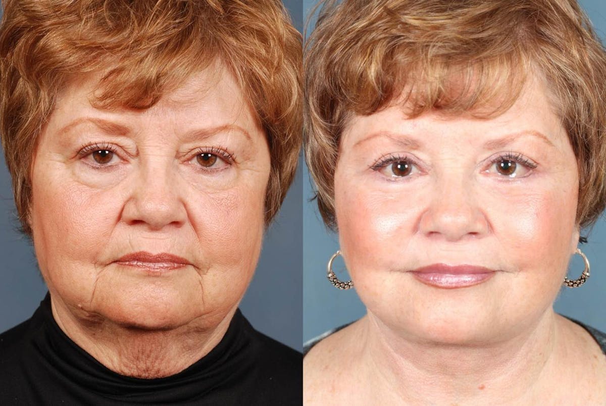 Facelift Before & After Gallery - Patient 292511 - Image 1