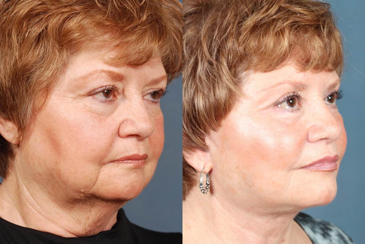 Facelift Before & After Gallery - Patient 292511 - Image 2