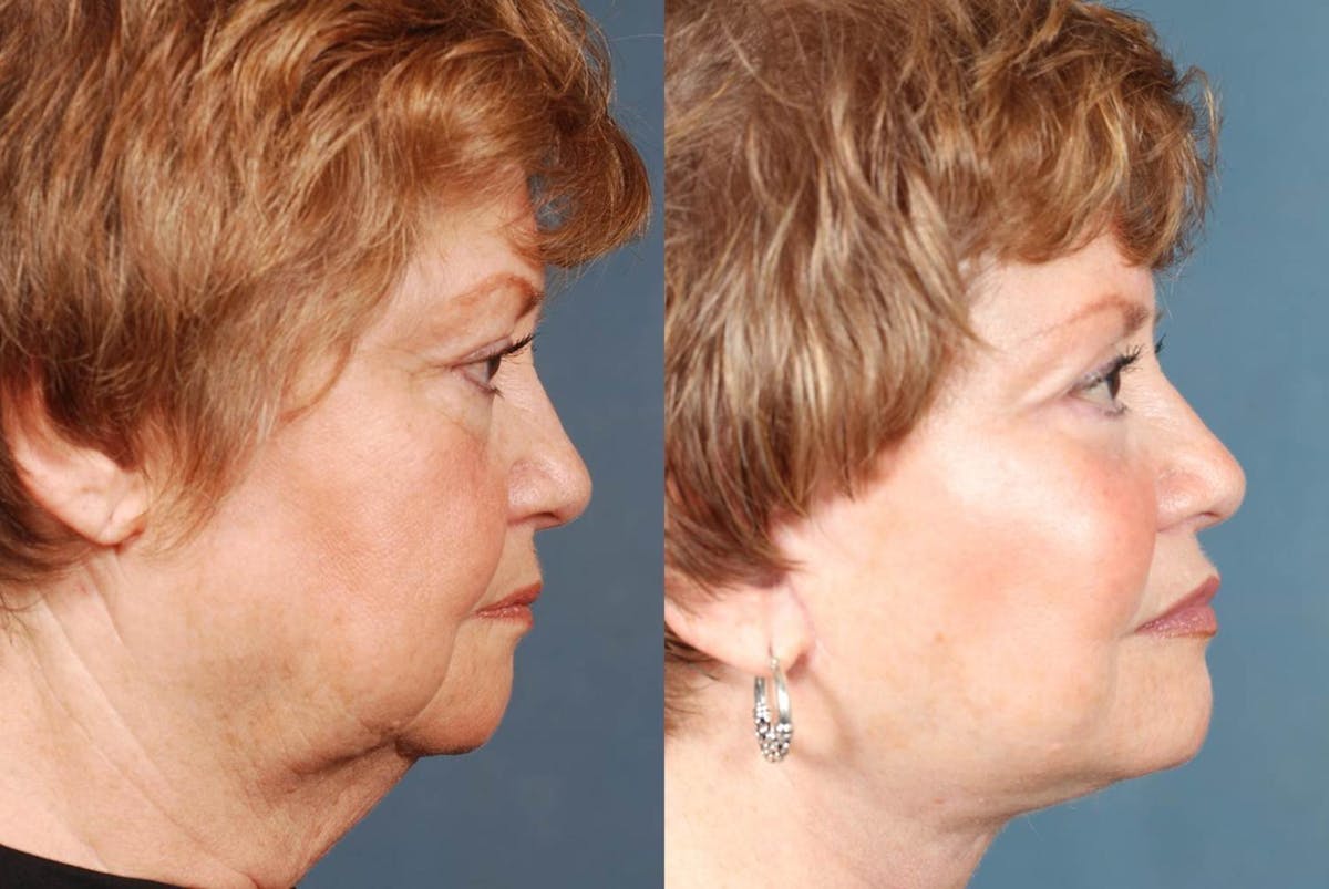 Facelift Before & After Gallery - Patient 292511 - Image 3