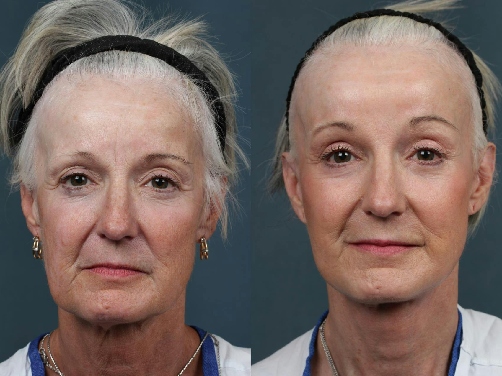 Facelift Before & After Gallery - Patient 105400 - Image 1