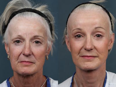 Facelift Before & After Gallery - Patient 105400 - Image 1