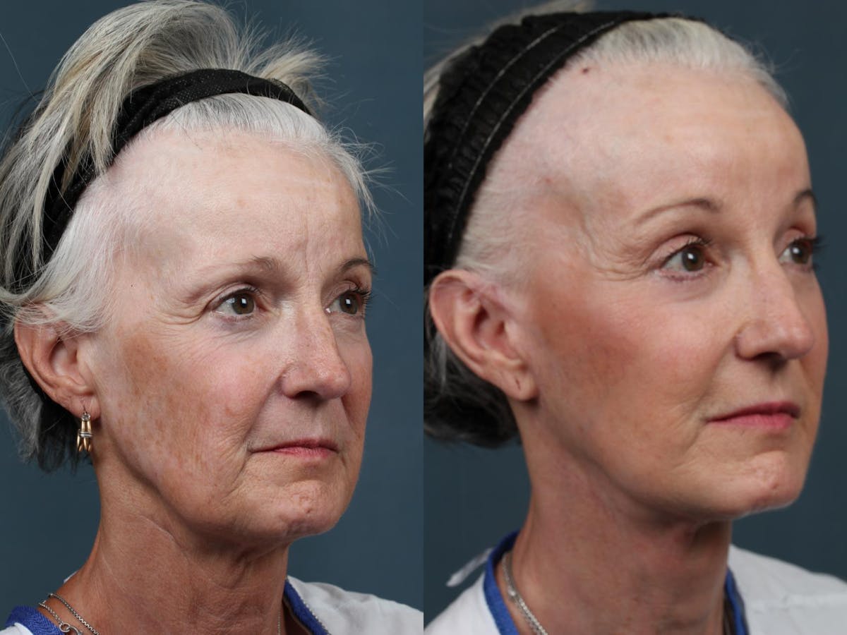 Facelift Before & After Gallery - Patient 105400 - Image 2