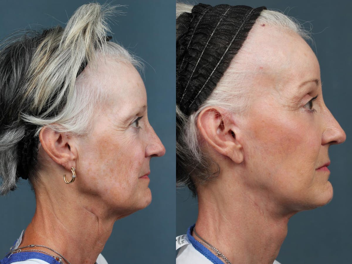 Facelift Before & After Gallery - Patient 105400 - Image 3
