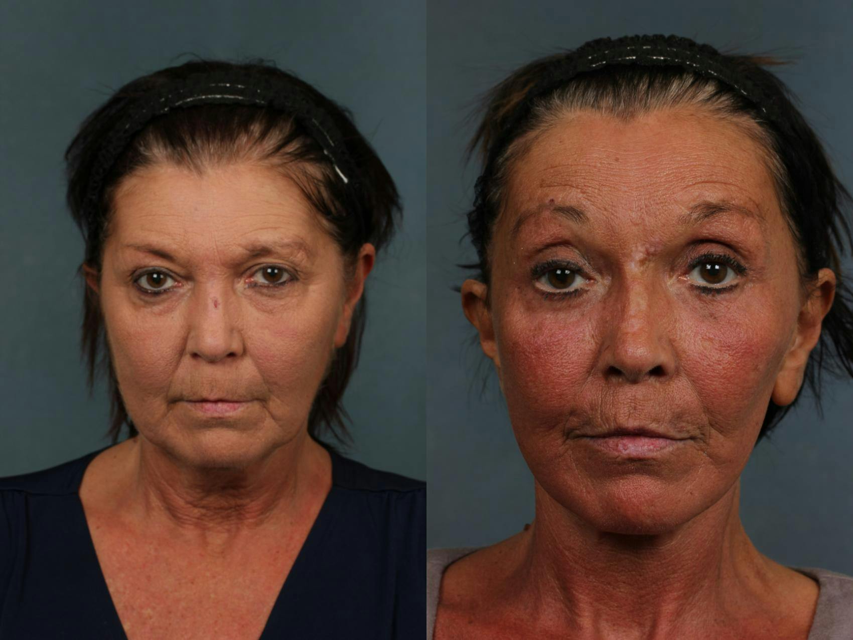 Facelift Before & After Gallery - Patient 213873 - Image 1
