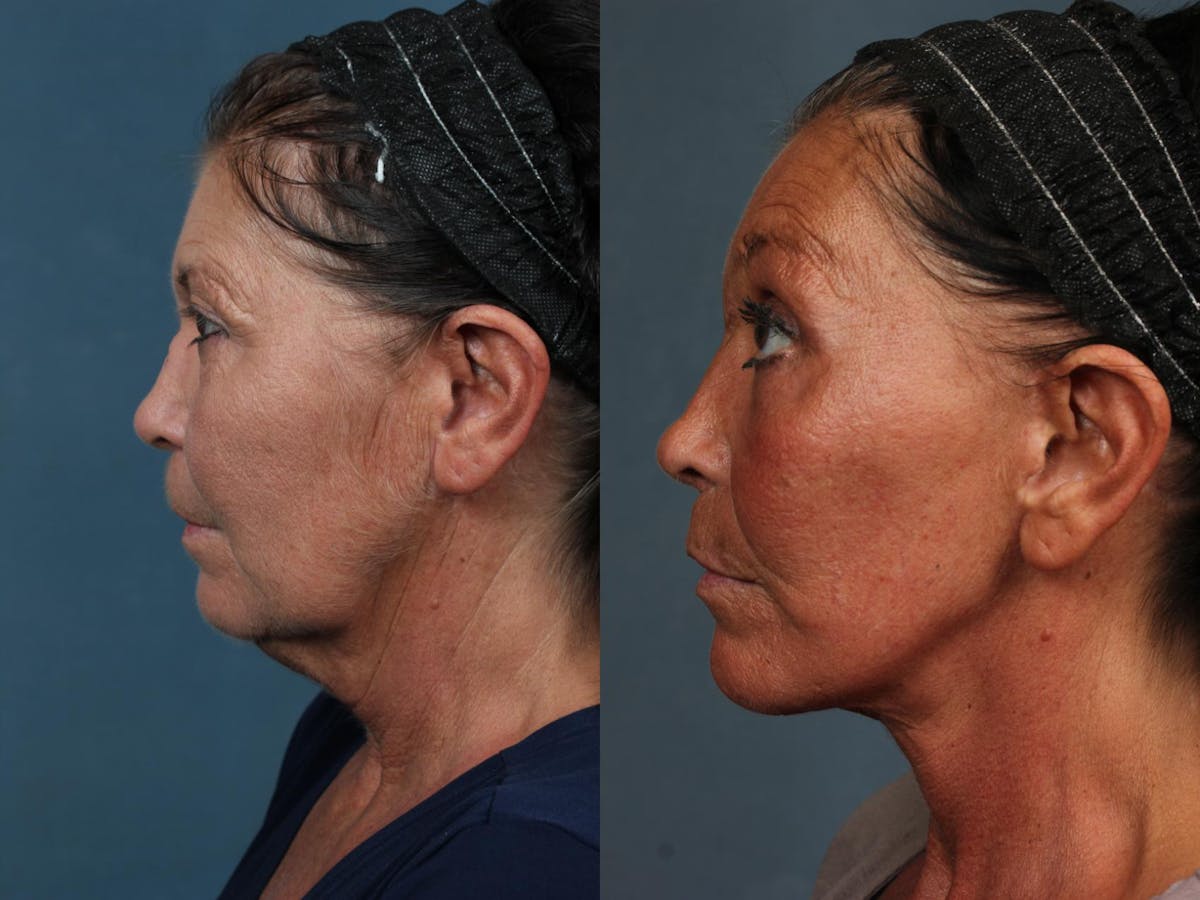 Facelift Before & After Gallery - Patient 213873 - Image 2