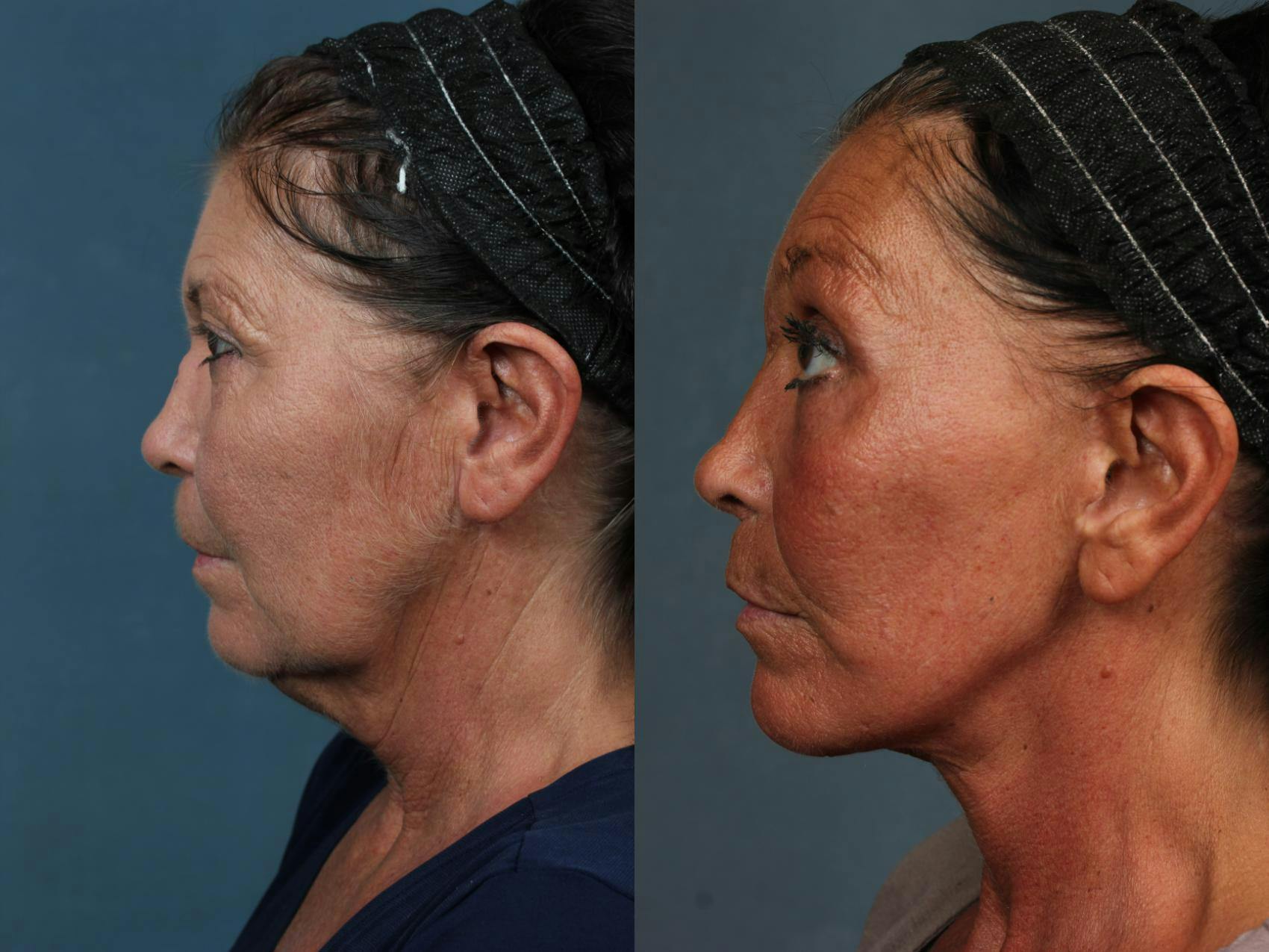 Facelift Before & After Gallery - Patient 213873 - Image 2