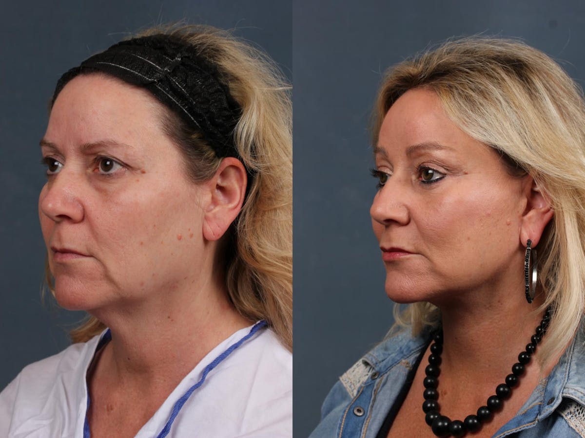 Facelift Before & After Gallery - Patient 312098 - Image 3