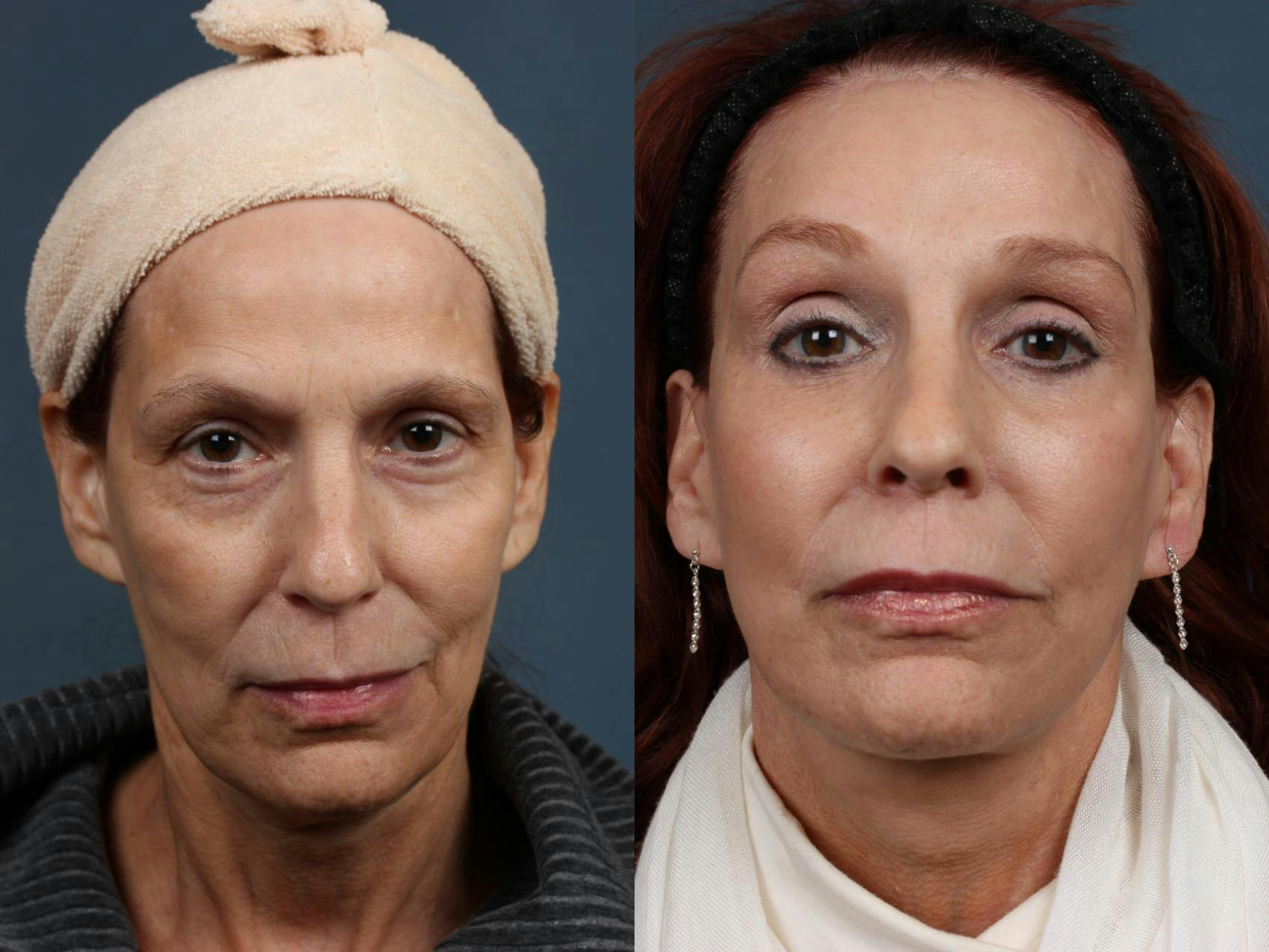 Facelift Before & After Gallery - Patient 261406 - Image 1