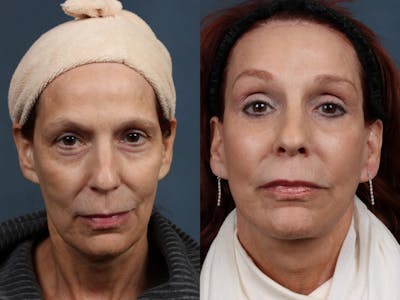 Facelift Before & After Gallery - Patient 261406 - Image 1
