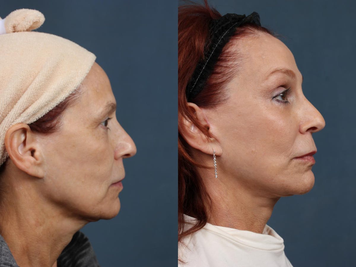 Facelift Before & After Gallery - Patient 261406 - Image 3