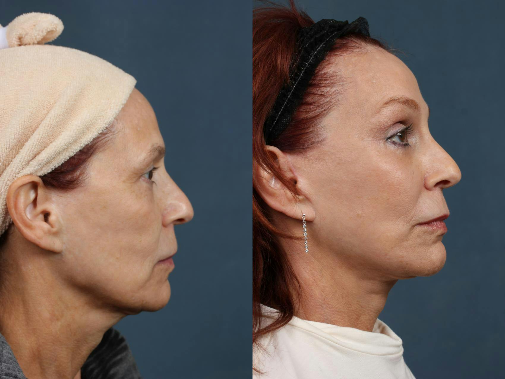 Facelift Before & After Gallery - Patient 261406 - Image 3