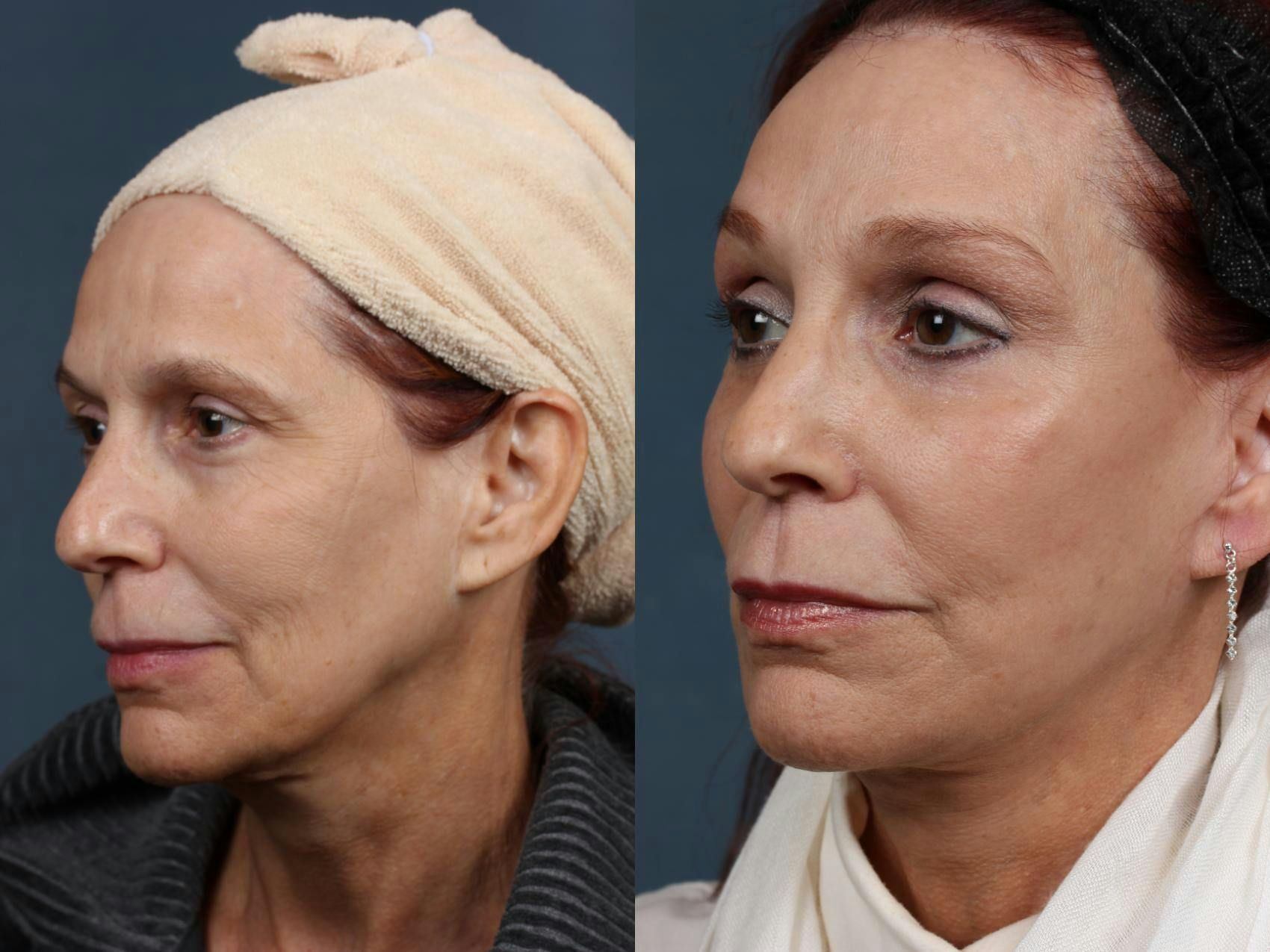 Facelift Before & After Gallery - Patient 261406 - Image 4