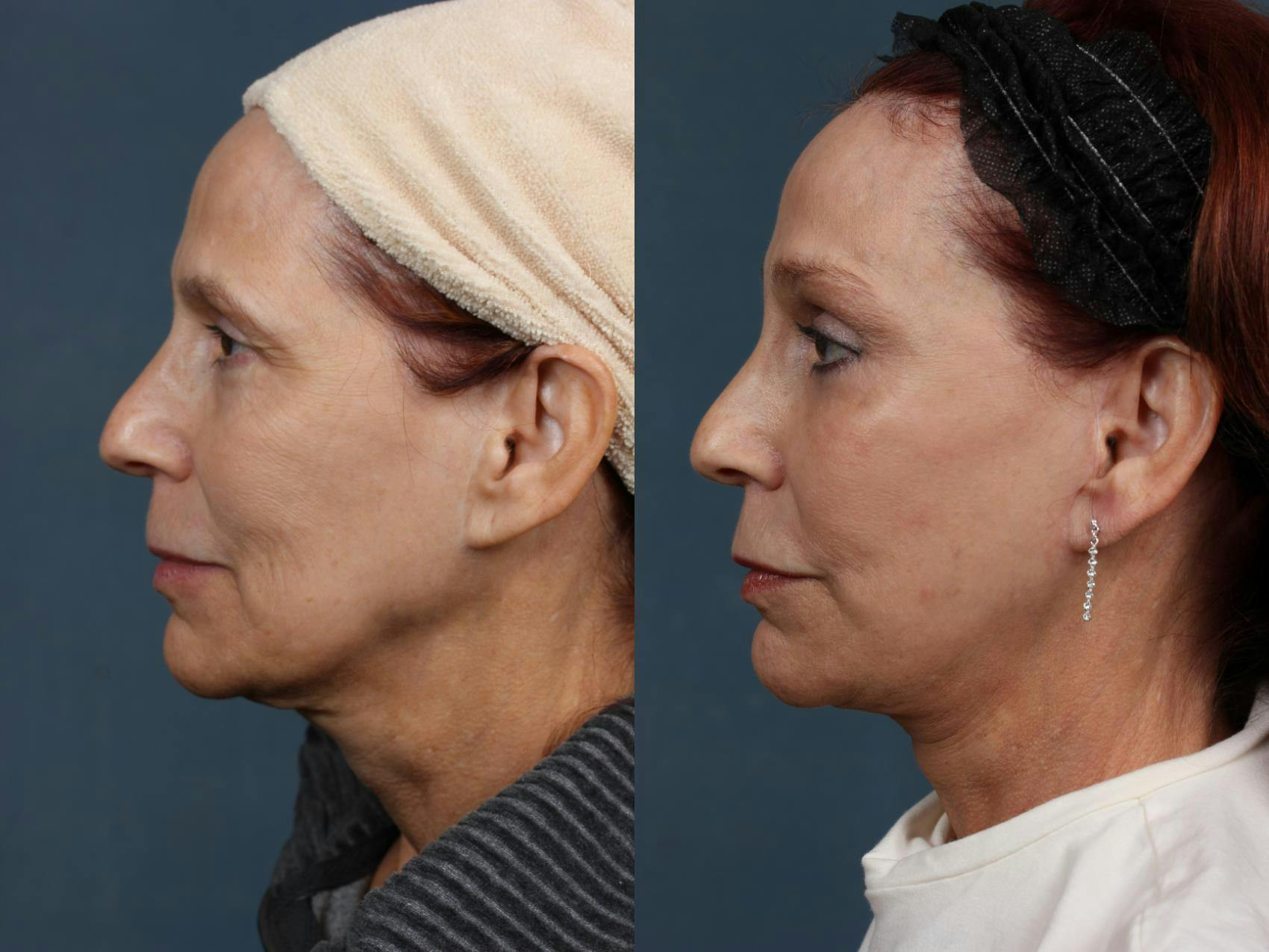 Facelift Before & After Gallery - Patient 261406 - Image 5