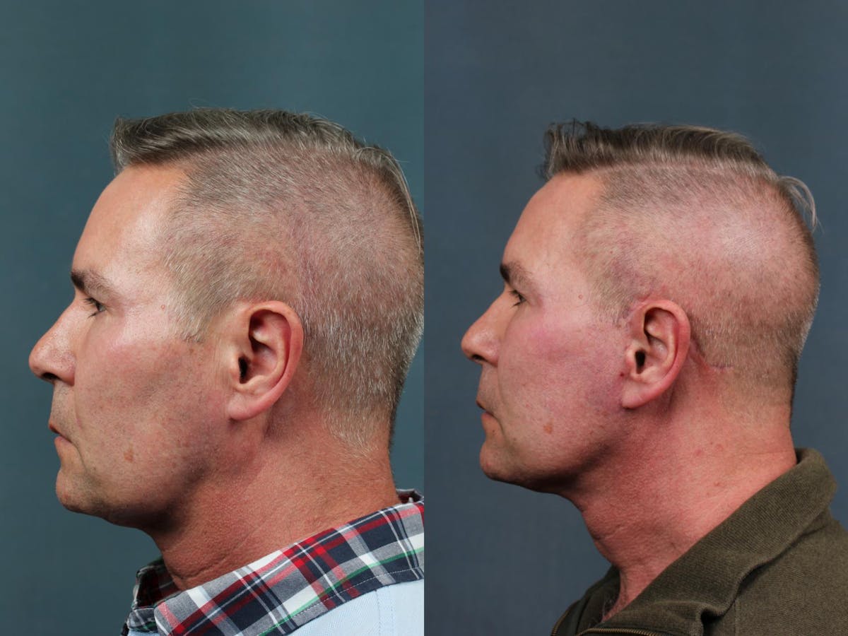 Facelift Before & After Gallery - Patient 387774 - Image 3