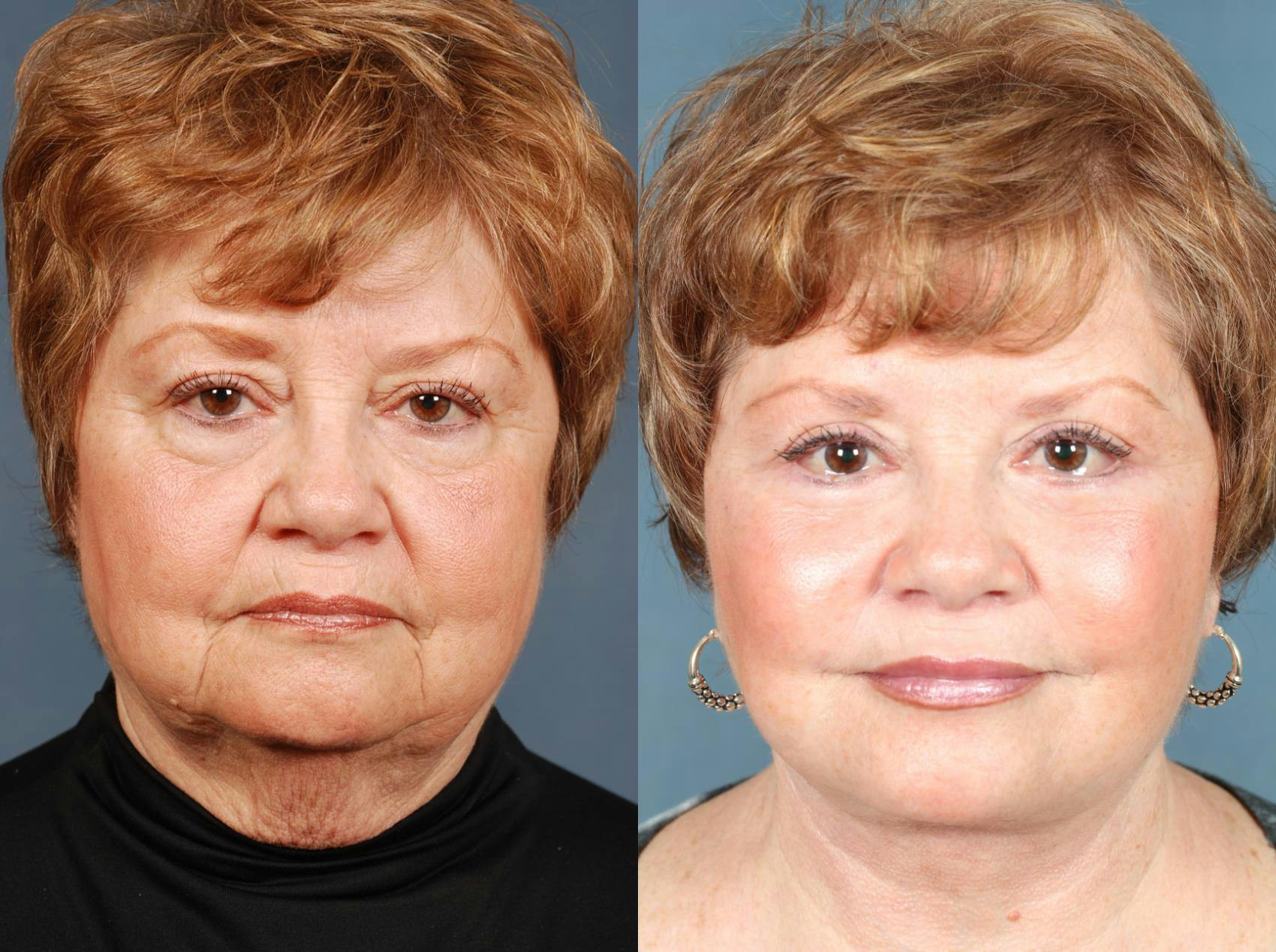Facelift Before & After Gallery - Patient 114886 - Image 1