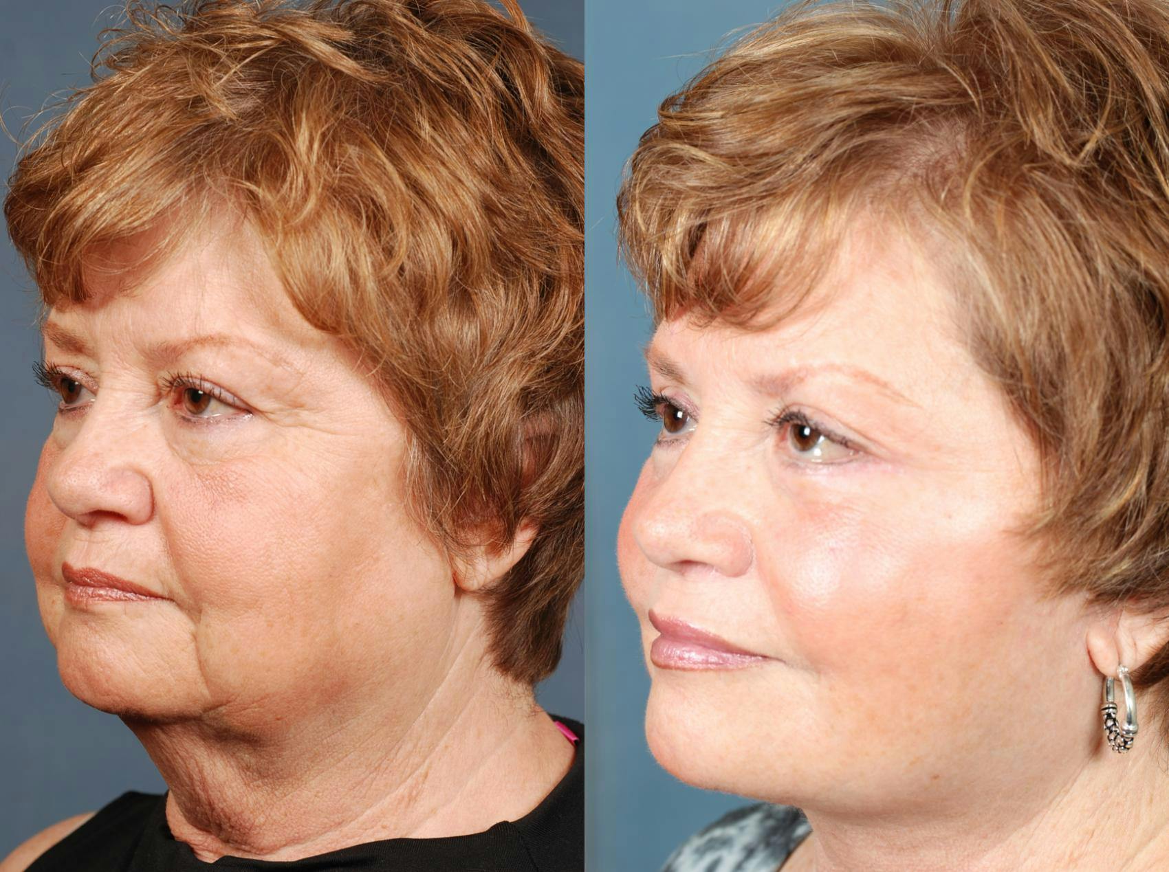 Facelift Before & After Gallery - Patient 114886 - Image 2
