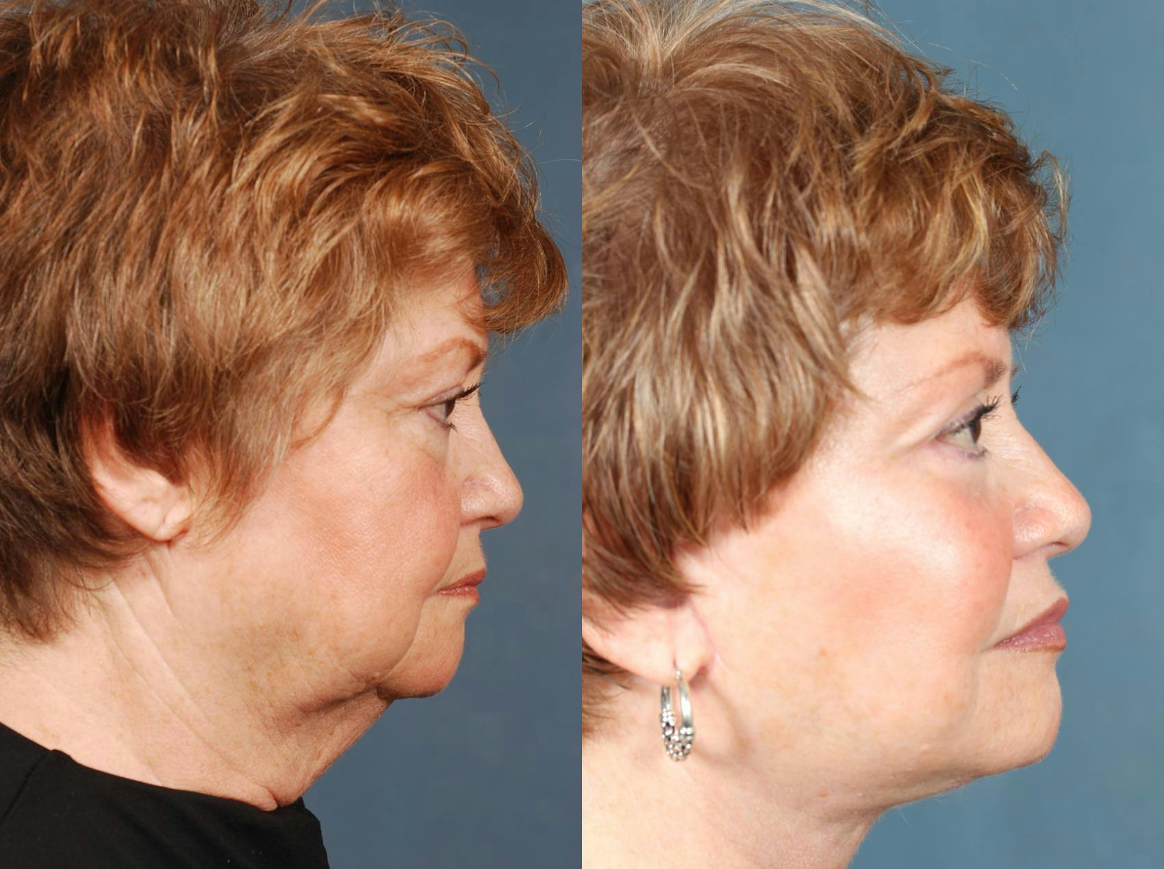 Facelift Before & After Gallery - Patient 114886 - Image 3