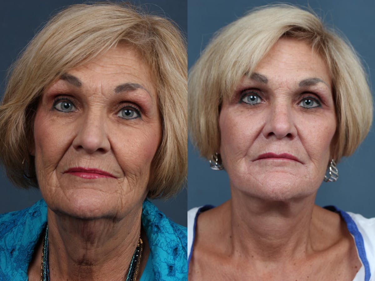 Facelift Before & After Gallery - Patient 238885 - Image 1