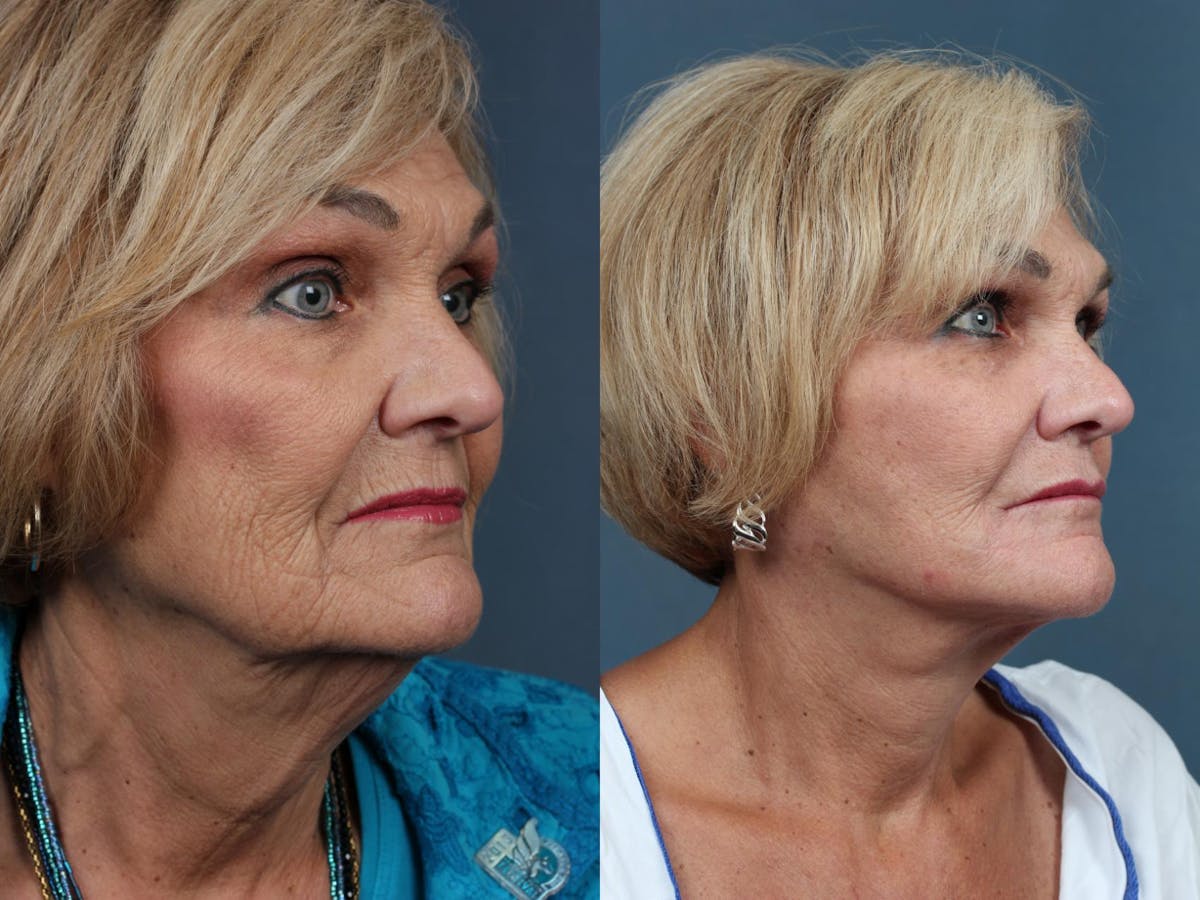 Facelift Before & After Gallery - Patient 238885 - Image 2
