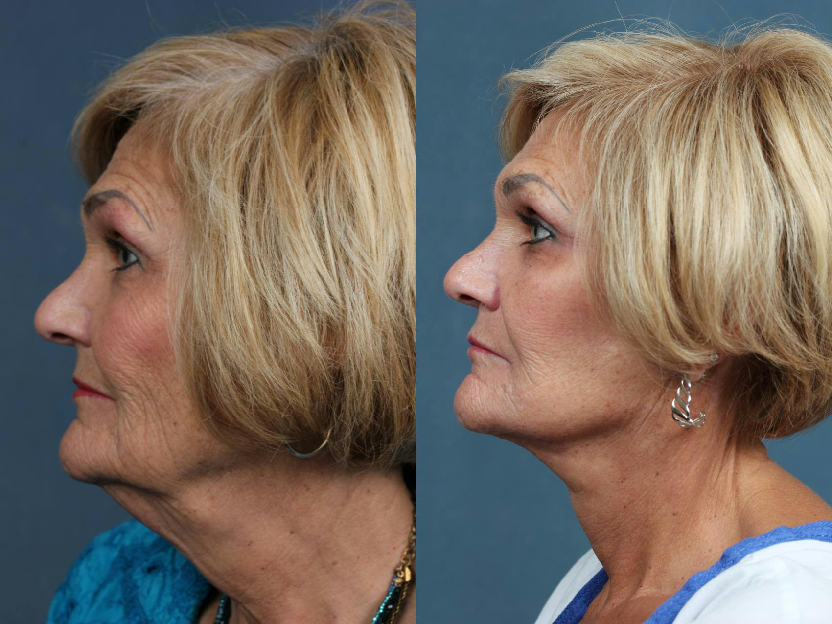 Facelift Before & After Gallery - Patient 238885 - Image 3