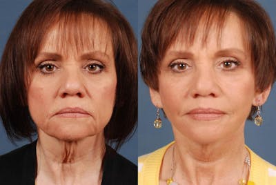 Facelift Before & After Gallery - Patient 297653 - Image 1