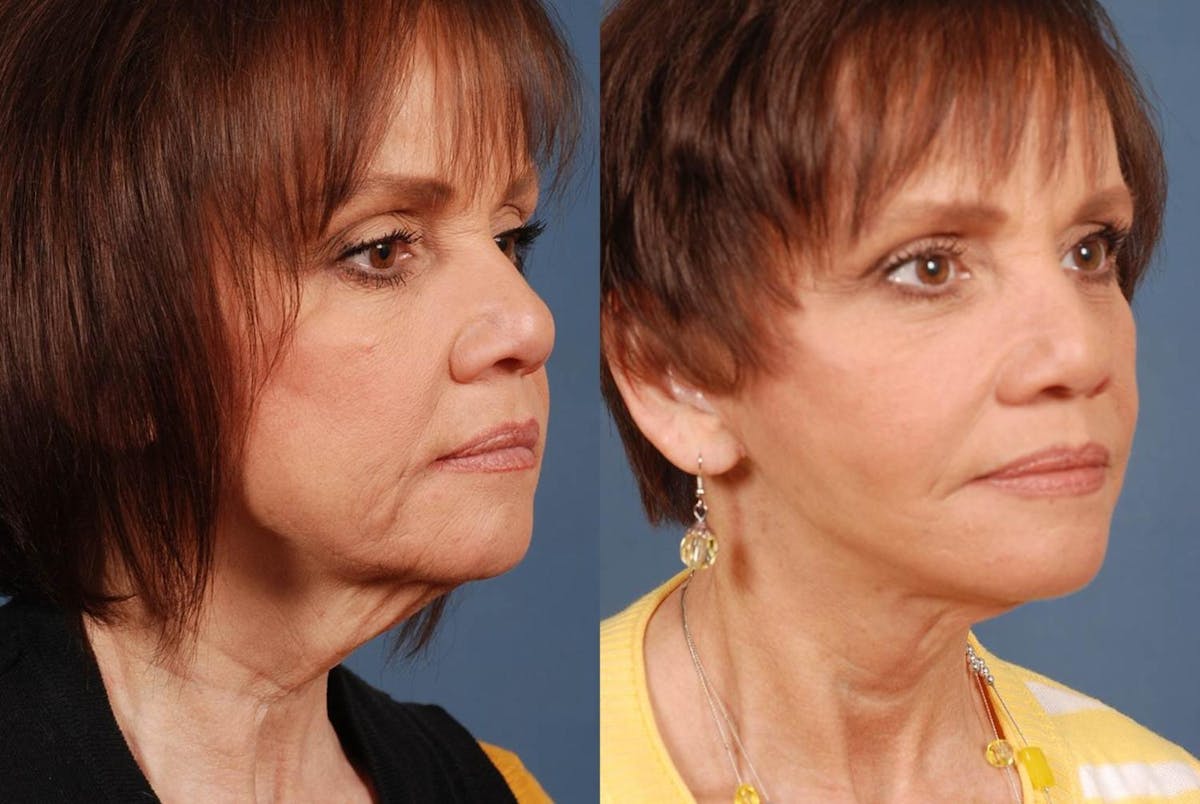 Facelift Before & After Gallery - Patient 297653 - Image 2