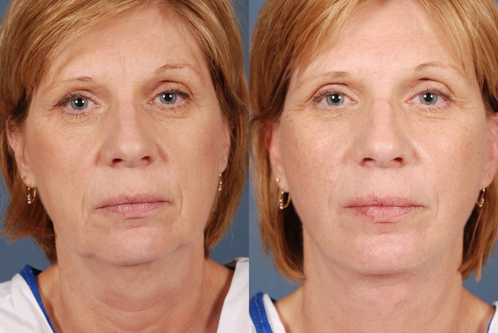 facelift results