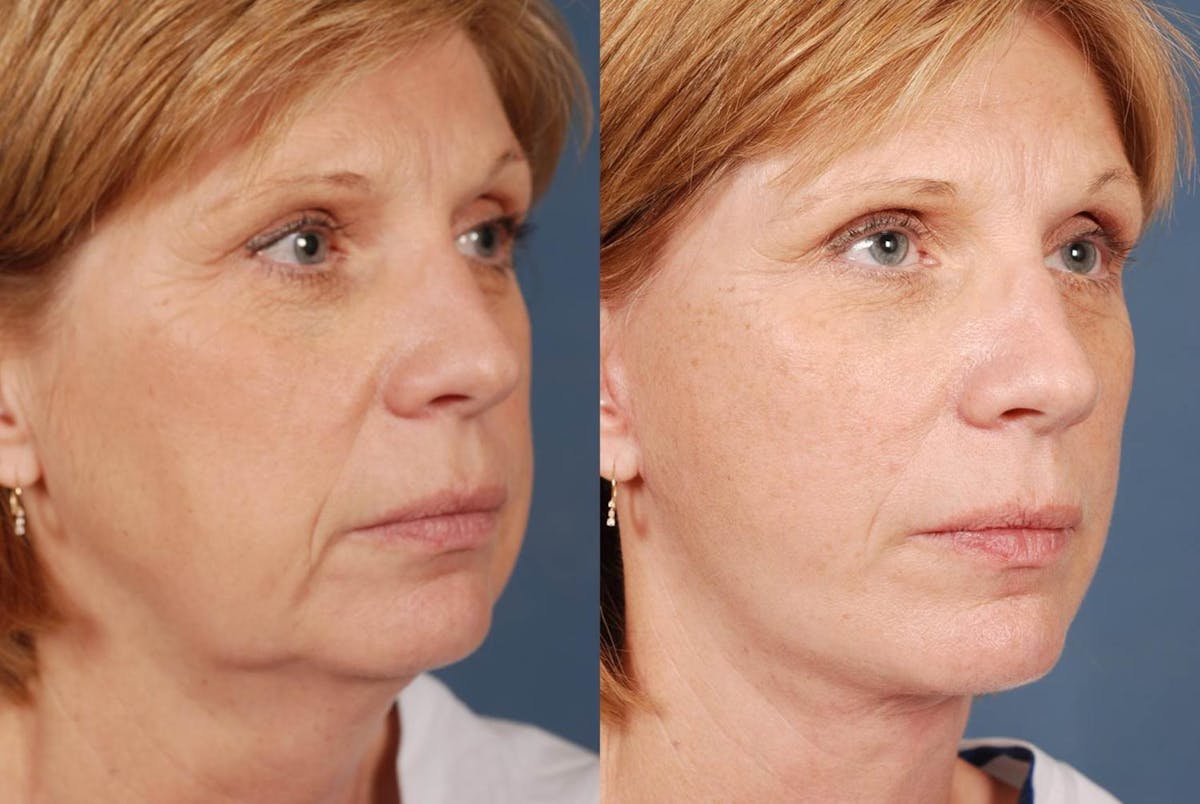Facelift Before & After Gallery - Patient 316452 - Image 2