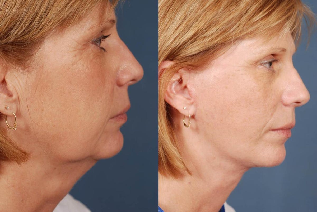 Facelift Before & After Gallery - Patient 316452 - Image 3