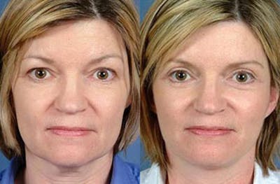 Facelift Before & After Gallery - Patient 257771 - Image 1