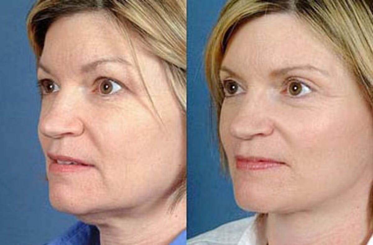 Facelift Before & After Gallery - Patient 257771 - Image 2