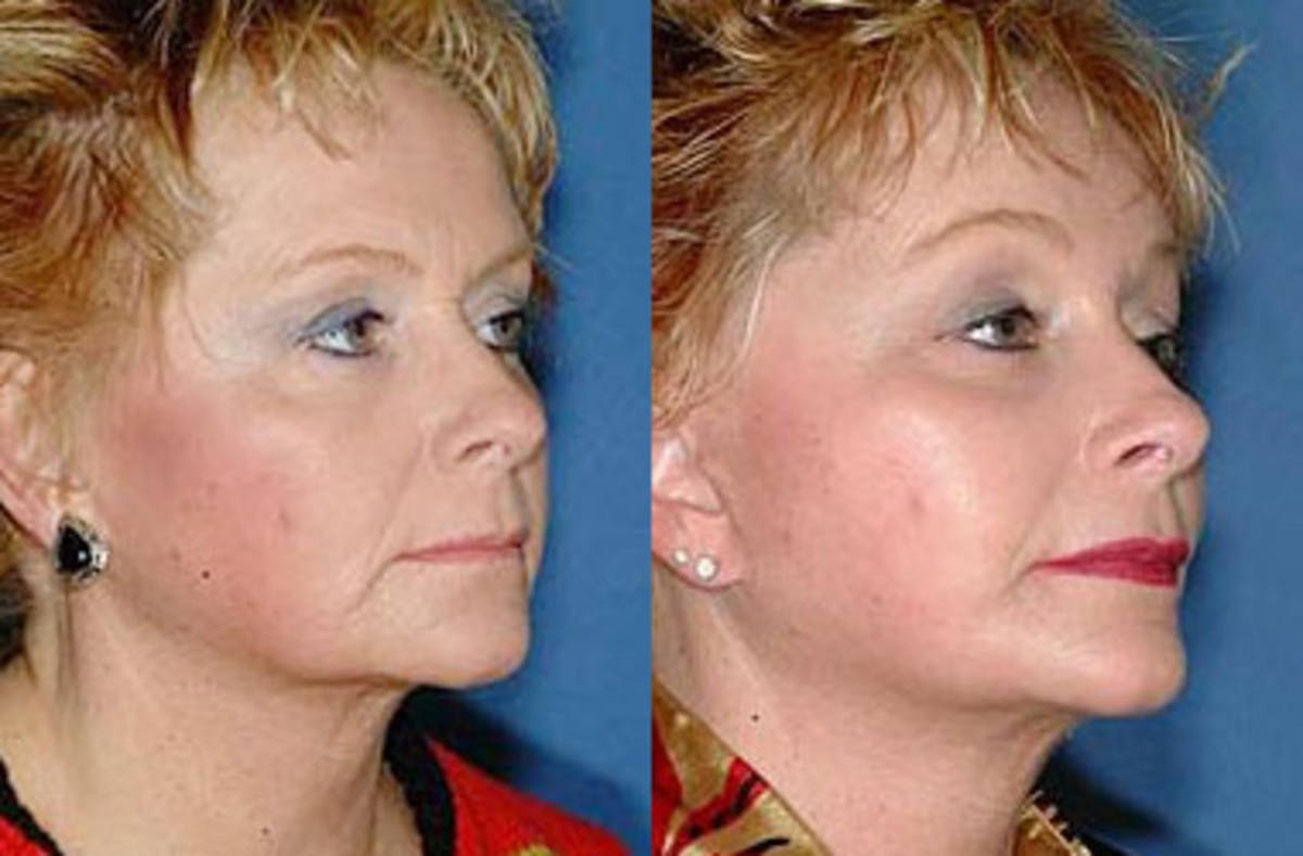 Facelift Before & After Gallery - Patient 170121 - Image 2