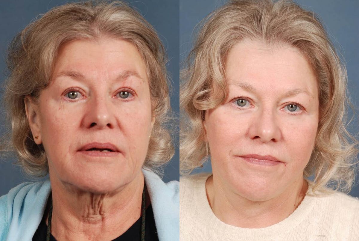 Facelift Before & After Gallery - Patient 201468 - Image 1