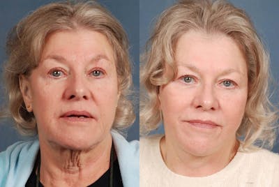 Facelift Before & After Gallery - Patient 201468 - Image 1