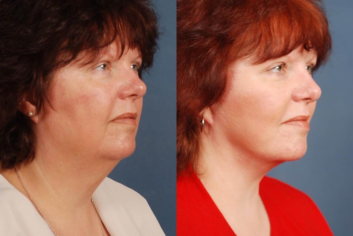 Facelift Before & After Gallery - Patient 197282 - Image 2