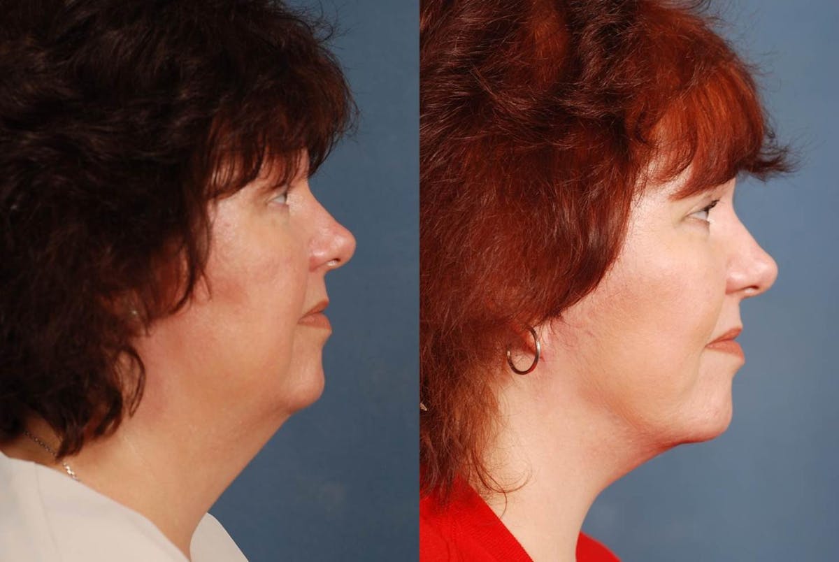 Facelift Before & After Gallery - Patient 197282 - Image 3