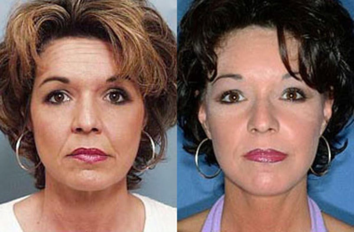 Facelift Before & After Gallery - Patient 166370 - Image 1