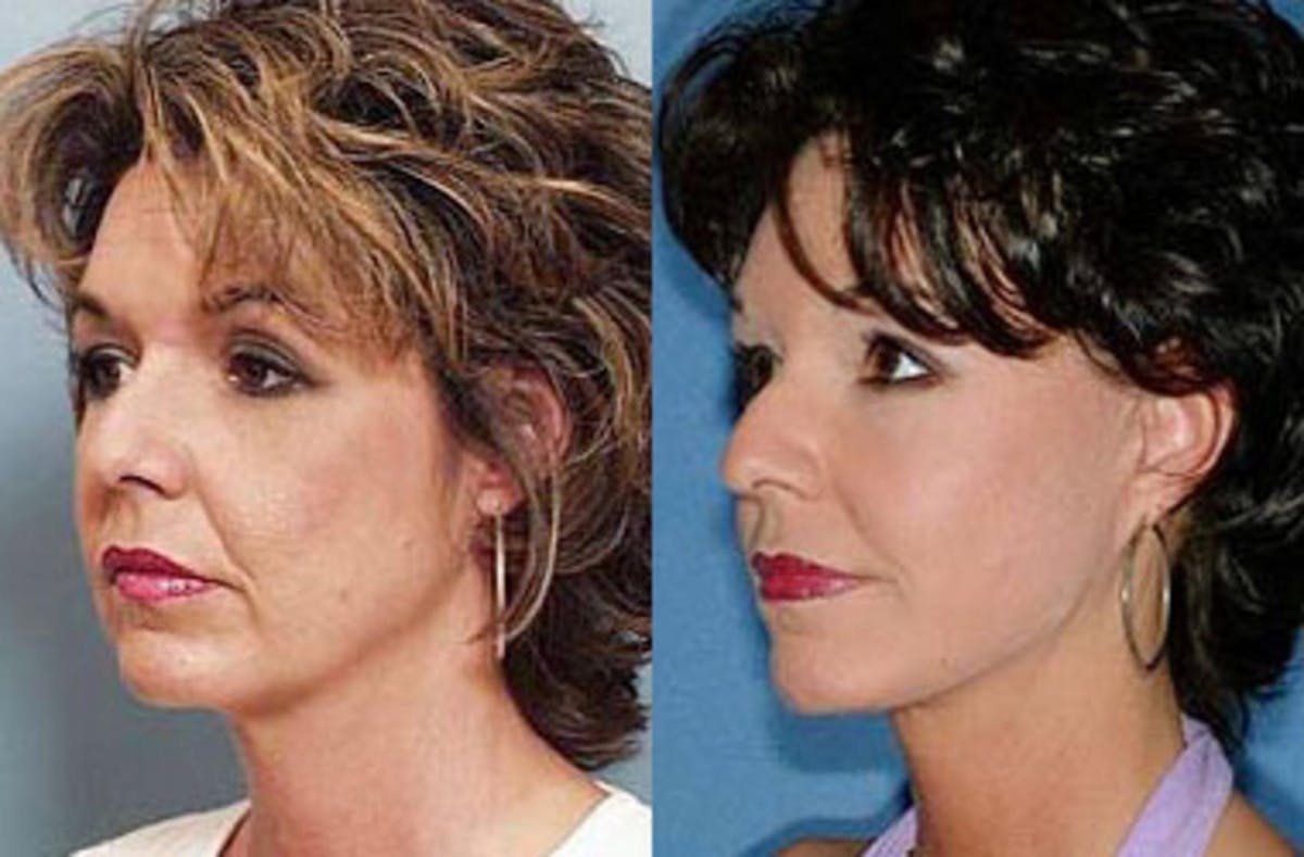 Facelift Before & After Gallery - Patient 166370 - Image 2