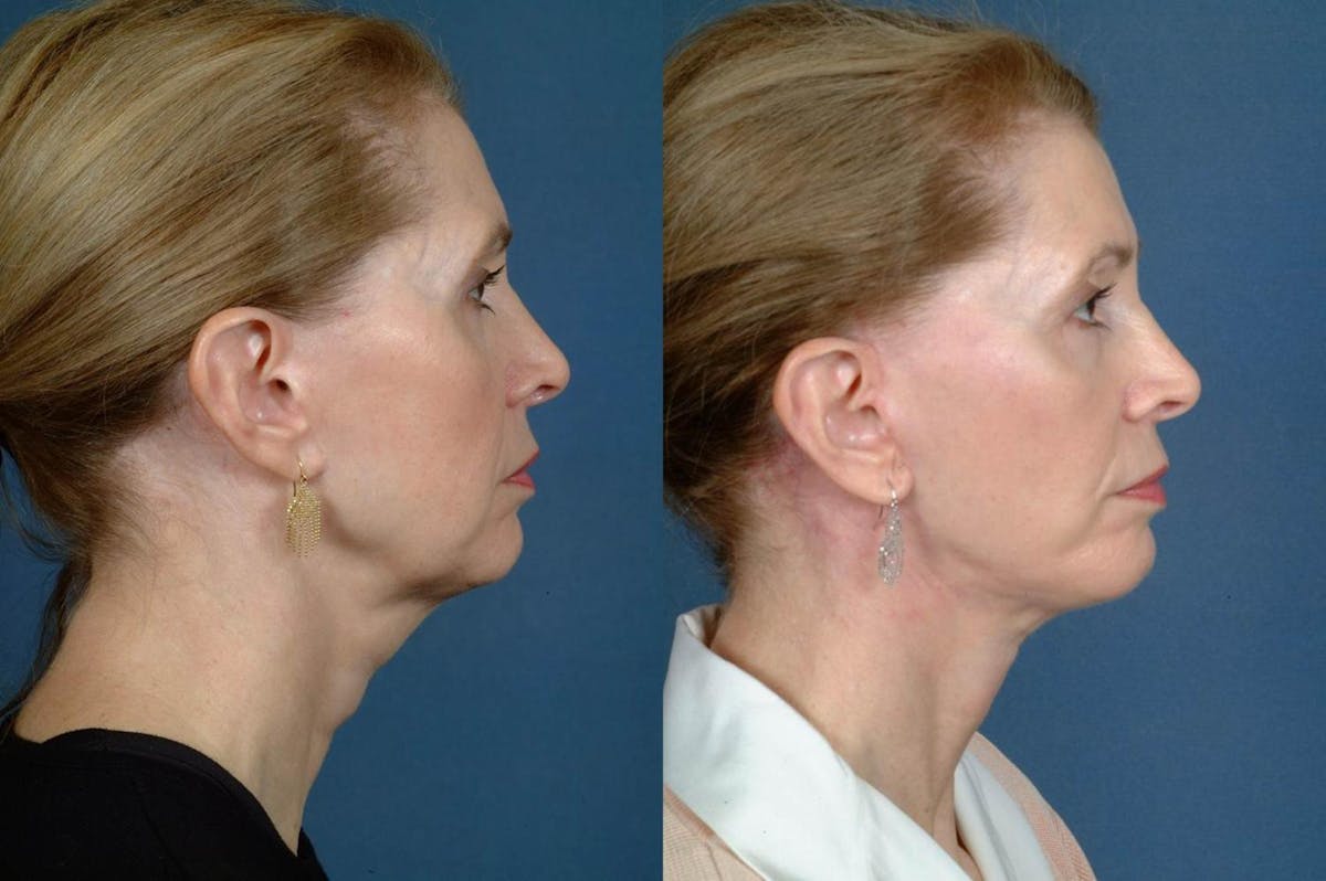 Facelift Before & After Gallery - Patient 173606 - Image 3