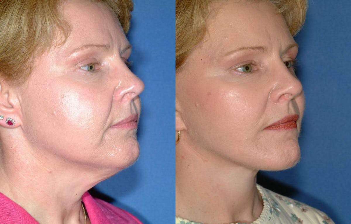 Facelift Before & After Gallery - Patient 148601 - Image 2
