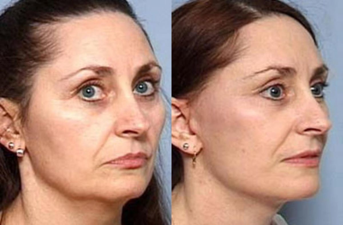 Facelift Before & After Gallery - Patient 380139 - Image 2