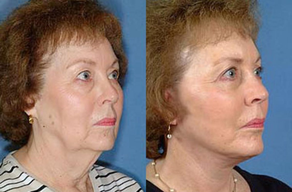 Facelift Before & After Gallery - Patient 203770 - Image 2